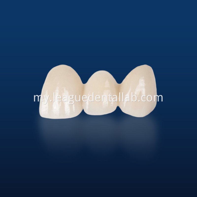 PFM,Metal crown,Fixed metal crown